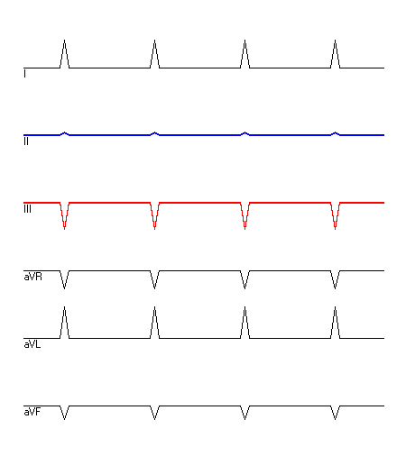 EKG mit hervorgehobenen Ableitungen