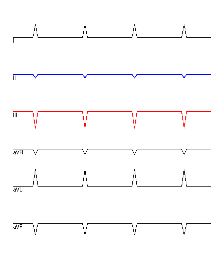 EKG mit hervorgehobenen Ableitungen