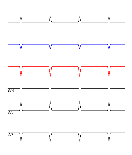 EKG mit hervorgehobenen Ableitungen