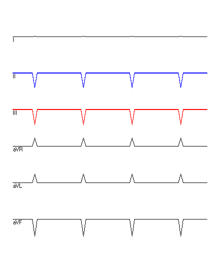 EKG mit hervorgehobenen Ableitungen