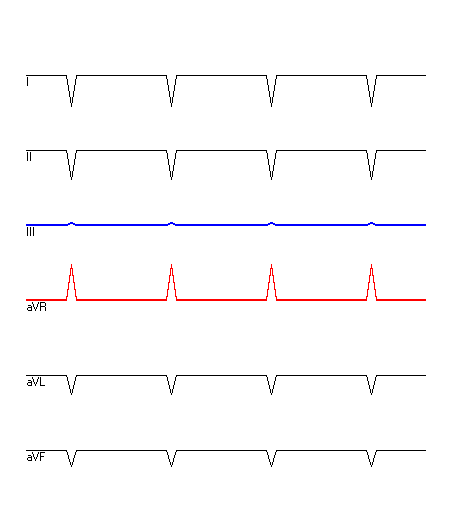 EKG mit hervorgehobenen Ableitungen