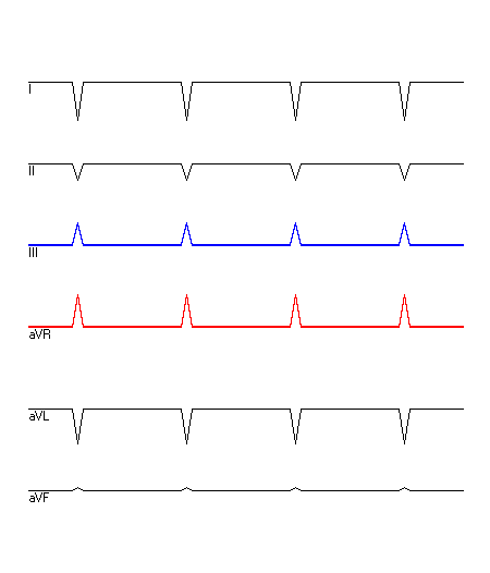 EKG mit hervorgehobenen Ableitungen