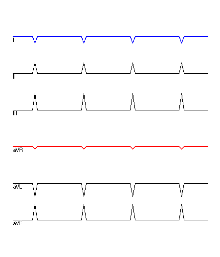 EKG mit hervorgehobenen Ableitungen