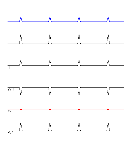 EKG mit hervorgehobenen Ableitungen