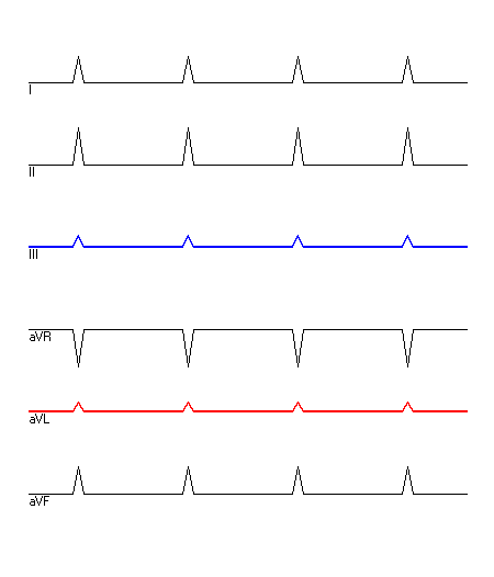 EKG mit hervorgehobenen Ableitungen