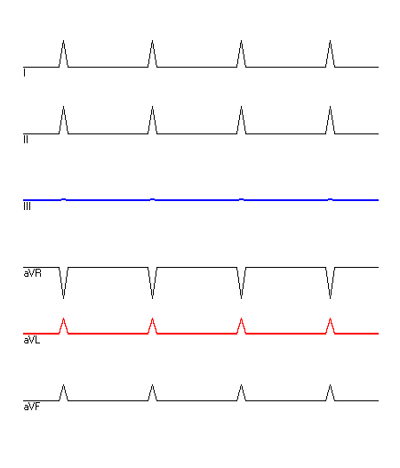 EKG mit hervorgehobenen Ableitungen