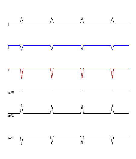 EKG mit hervorgehobenen Ableitungen