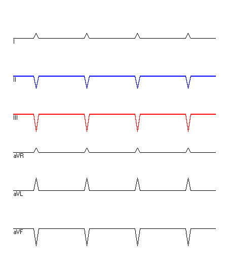 EKG mit hervorgehobenen Ableitungen