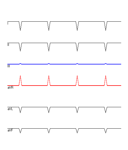 EKG mit hervorgehobenen Ableitungen