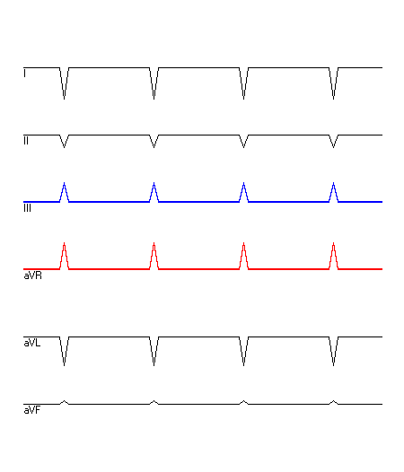 EKG mit hervorgehobenen Ableitungen