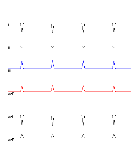 EKG mit hervorgehobenen Ableitungen