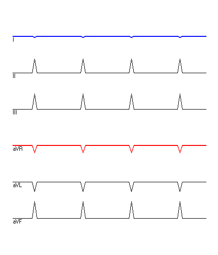 EKG mit hervorgehobenen Ableitungen