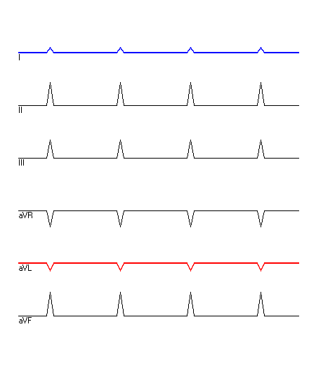 EKG mit hervorgehobenen Ableitungen