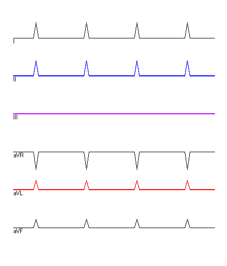 EKG mit hervorgehobenen Ableitungen