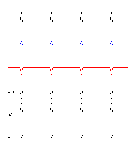 EKG mit hervorgehobenen Ableitungen