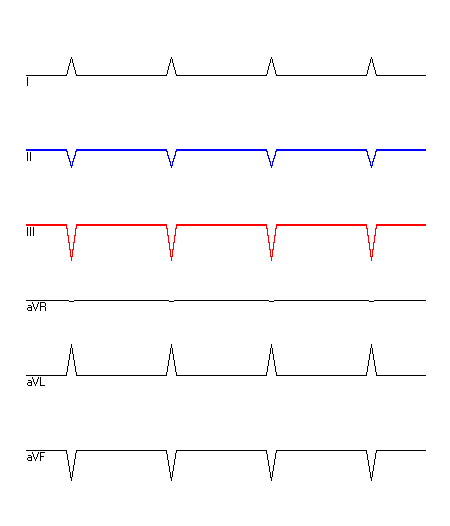 EKG mit hervorgehobenen Ableitungen