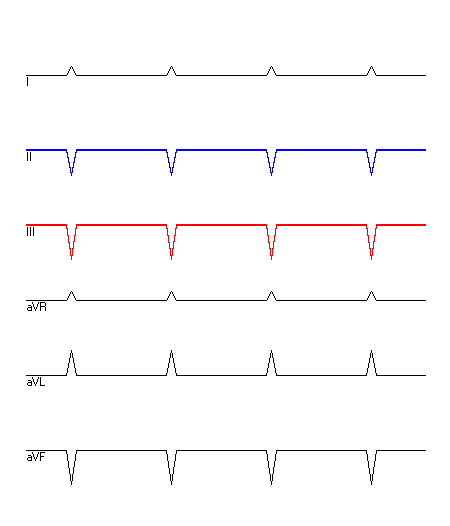 EKG mit hervorgehobenen Ableitungen