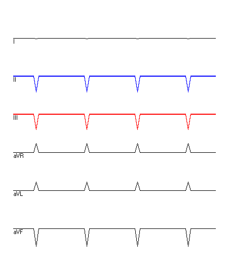 EKG mit hervorgehobenen Ableitungen