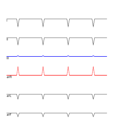 EKG mit hervorgehobenen Ableitungen