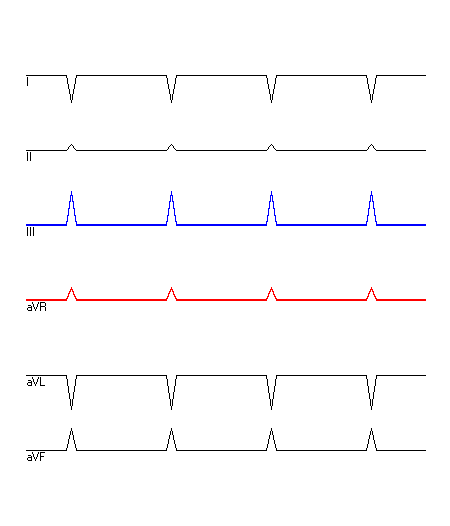 EKG mit hervorgehobenen Ableitungen