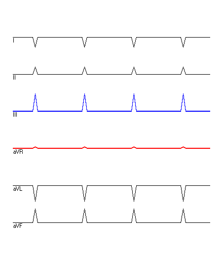 EKG mit hervorgehobenen Ableitungen