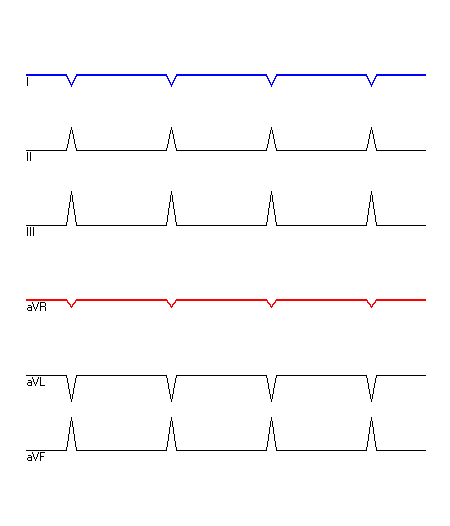 EKG mit hervorgehobenen Ableitungen