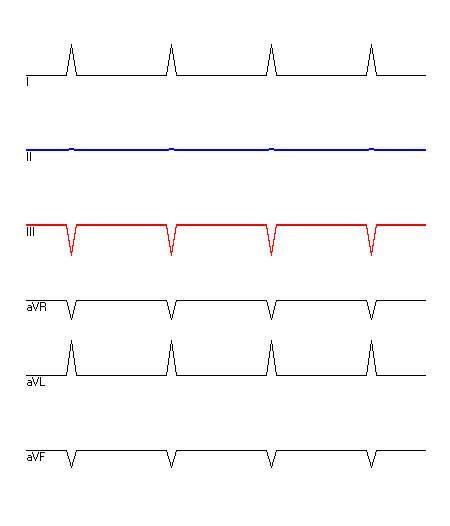 EKG mit hervorgehobenen Ableitungen