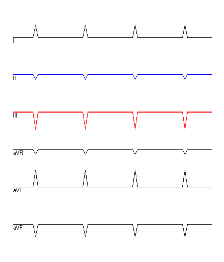 EKG mit hervorgehobenen Ableitungen