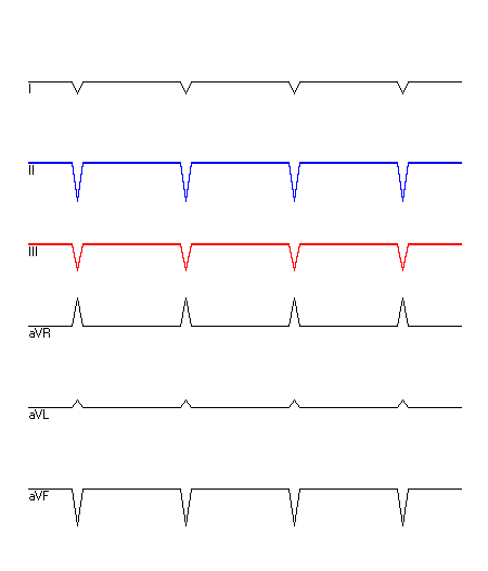 EKG mit hervorgehobenen Ableitungen