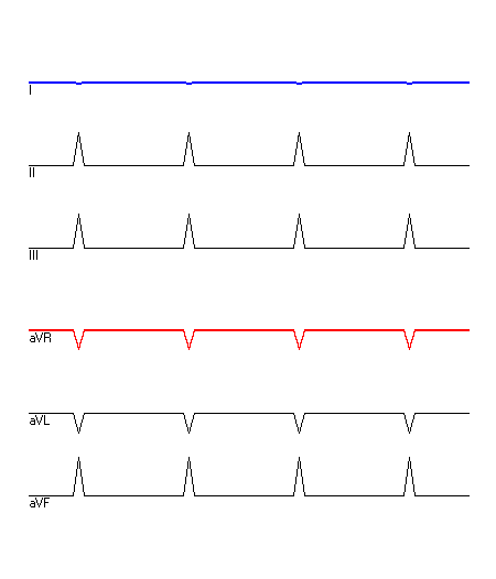 EKG mit hervorgehobenen Ableitungen