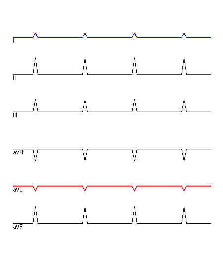 EKG mit hervorgehobenen Ableitungen