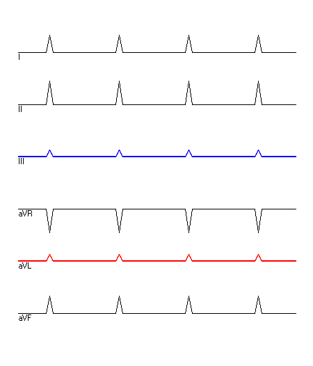 EKG mit hervorgehobenen Ableitungen