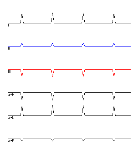 EKG mit hervorgehobenen Ableitungen