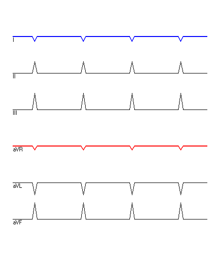 EKG mit hervorgehobenen Ableitungen