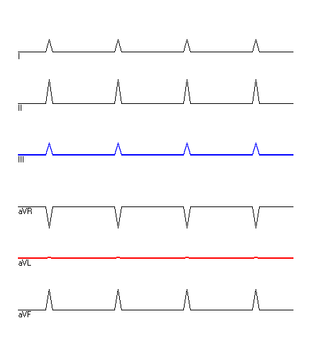 EKG mit hervorgehobenen Ableitungen