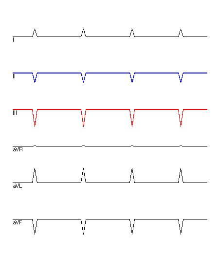 EKG mit hervorgehobenen Ableitungen