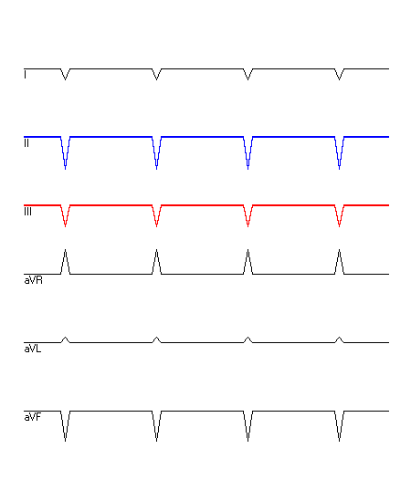 EKG mit hervorgehobenen Ableitungen