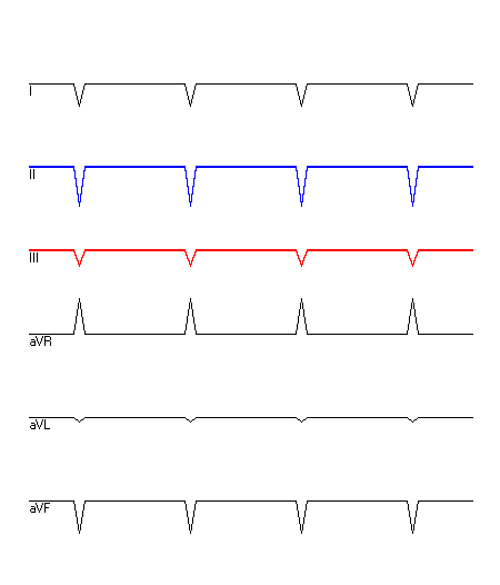 EKG mit hervorgehobenen Ableitungen