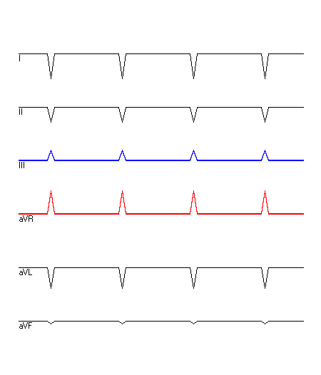 EKG mit hervorgehobenen Ableitungen