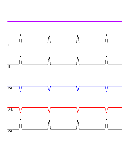 EKG mit hervorgehobenen Ableitungen