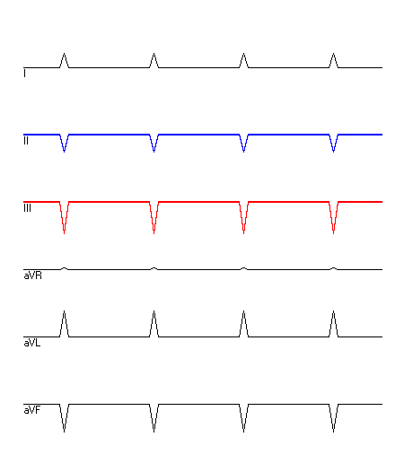 EKG mit hervorgehobenen Ableitungen