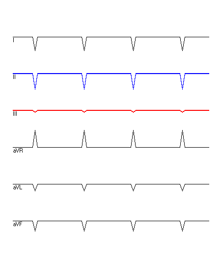 EKG mit hervorgehobenen Ableitungen