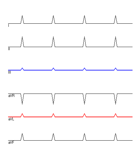 EKG mit hervorgehobenen Ableitungen