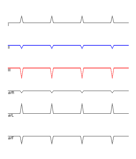 EKG mit hervorgehobenen Ableitungen