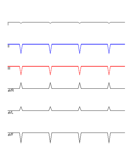 EKG mit hervorgehobenen Ableitungen