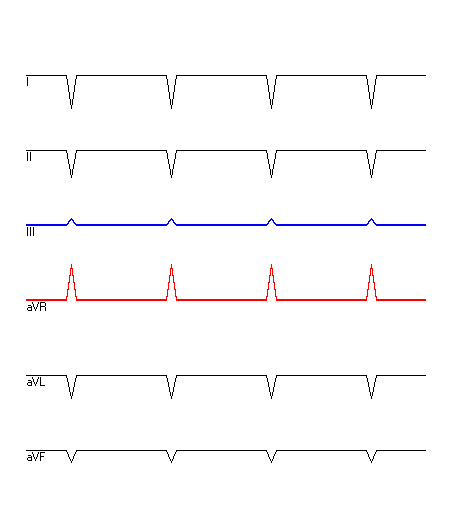 EKG mit hervorgehobenen Ableitungen