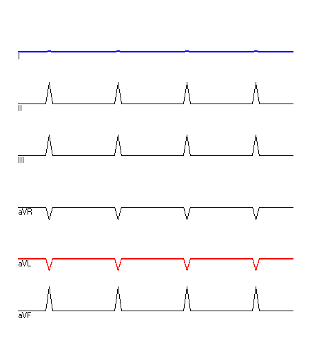 EKG mit hervorgehobenen Ableitungen