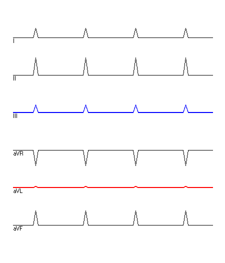 EKG mit hervorgehobenen Ableitungen