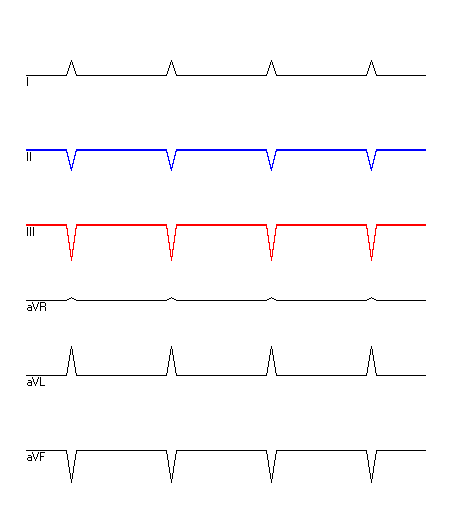 EKG mit hervorgehobenen Ableitungen