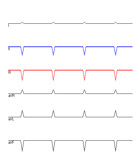 EKG mit hervorgehobenen Ableitungen